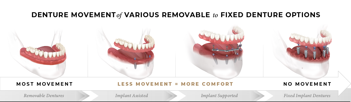 Denture Movement in Removable to Fixed Dentures