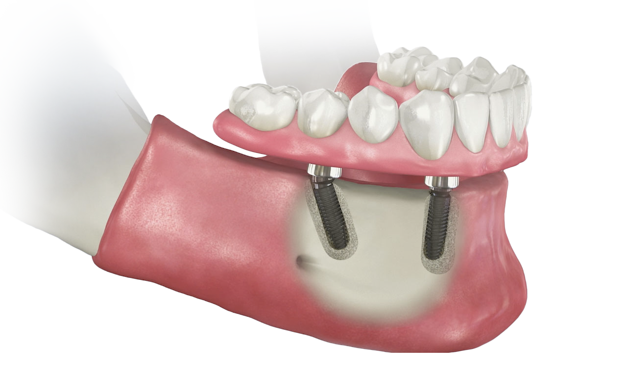 Fixed Implant Dentures