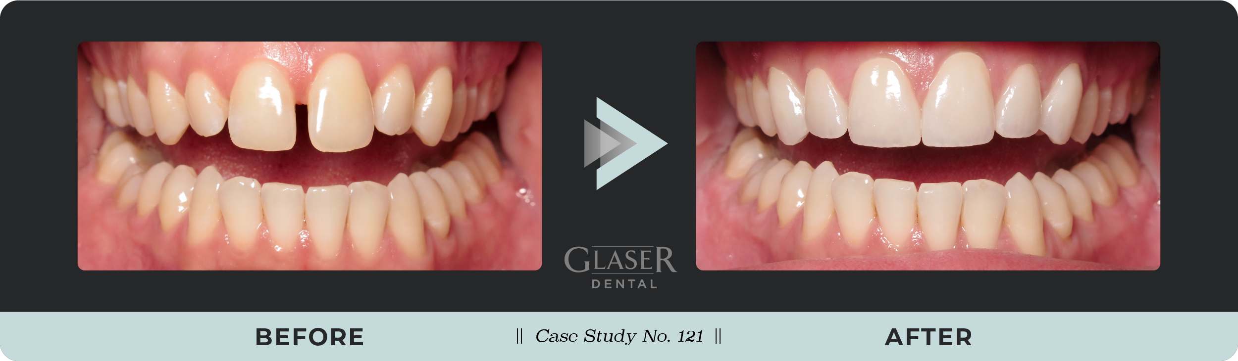 Before & After Photo Comparing Dental Problem and Results of Solution
