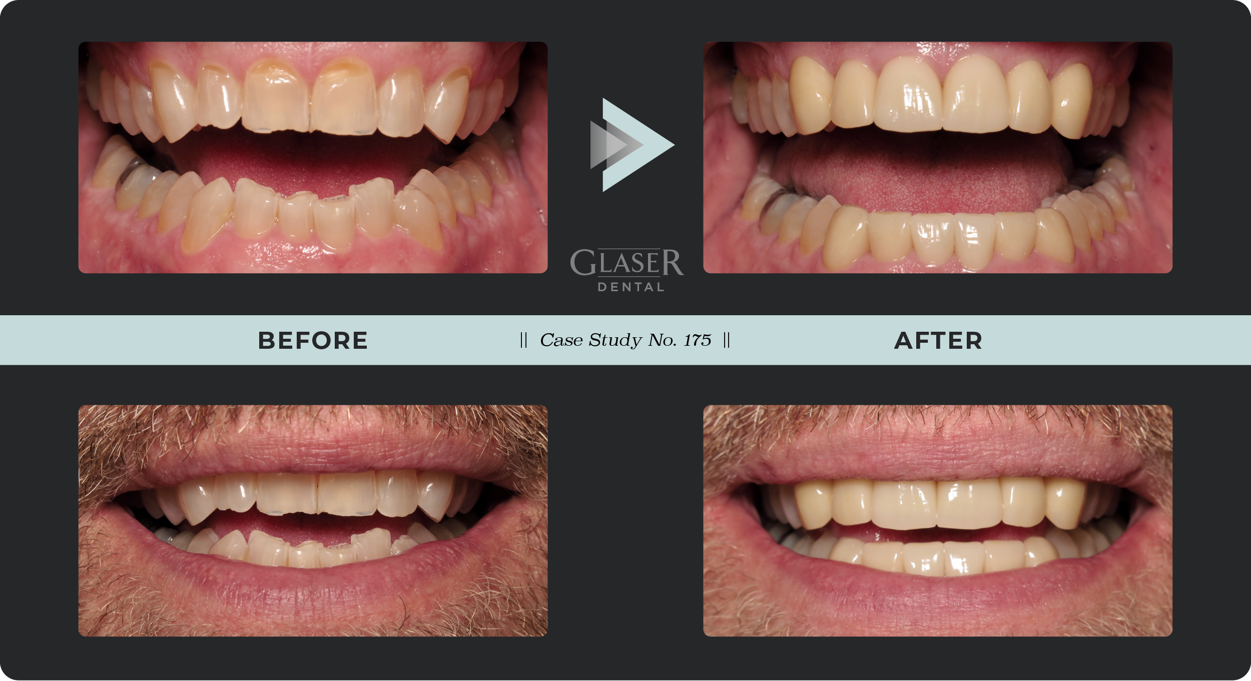 Before & After Photo Comparing Dental Problem and Results of Solution