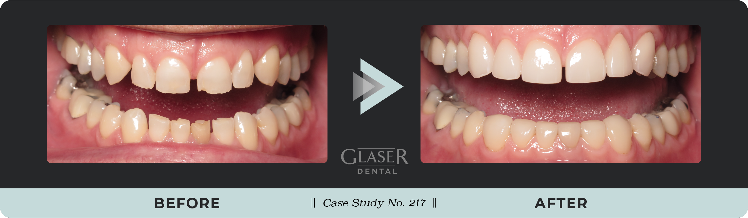 Before & After Photo Comparing Dental Problem and Results of Solution